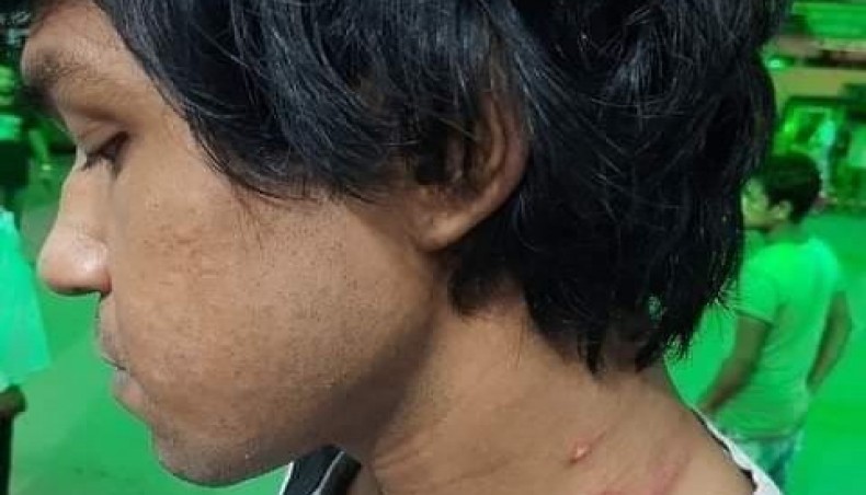 A collected photo shows marks of injury on the neck of a detained Chhatra Union leader