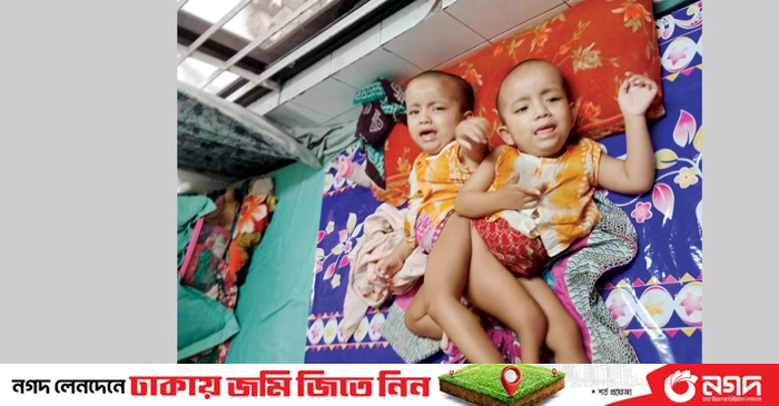 Conjoined Twins Separated